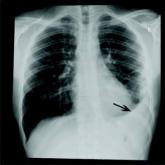 Macrolide adds no benefit to pneumonia treatment in HIV patients