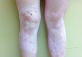 Multiple asymptomatic light-colored patches on the bilateral arms and legs of an adolescent female. 