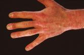 Reciprocal risks found between psoriatic disease and uveitis