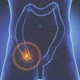 Jury still out on appendectomy vs. antibiotics-first approach