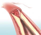 HIV-positive patients may be at greater risk of atherosclerosis