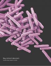 Strong evidence for tuberculosis screening before psoriasis, PsA biologic therapy