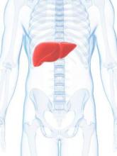 Nonalcoholic hepatic steatosis a key indicator for liver transplant