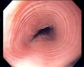 PPIs caused remission in about half of esophageal eosinophilia cases