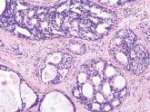 DCIS recurrences have declined significantly