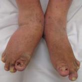 Early psoriatic arthritis treatment with etanercept gives better outcomes