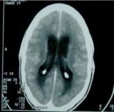 Tuberculous meningitis: Intensified anti-TB therapy not useful