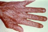 Mass drug administration controls scabies in endemic areas