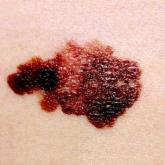Handheld device illuminates possible routes of melanoma metastases