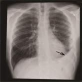 Hospitalization for pneumonia raises CVD risk