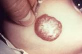 Propranolol Effective in 60% of Infantile Hemangiomas