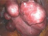 Fibroids, endometriosis linked to chemical exposures cost Europe $1.5 billion a year