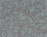 Sickle cell trait raises exertional rhabdomyolysis risk