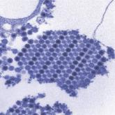 Severe sepsis and septic shock syndrome linked to chikungunya