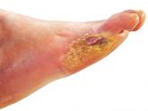 Diabetic foot ulcers linked to cognitive decline