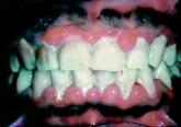 Fix the gums, save the heart?
