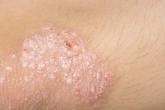 Psoriasis and Acne Worse in Winter, Milder in Summer