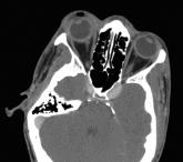  Liver Abscess and Metastatic Endophthalmitis