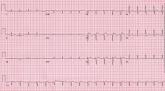 Brugada Syndrome Unmasked by a Mosquito