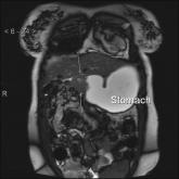 Metastatic Lobular Breast Carcinoma