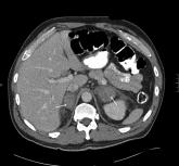 Bilateral Adrenal Hemorrhage Complication