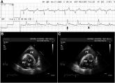 Electrical Alternans and Pulsus Paradoxus
