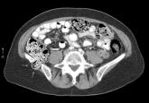 Incisional Iliac Hernia