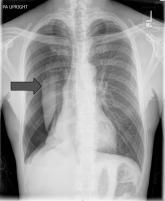 Pneumothorax in a Patient With COPD