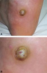 More Than a Plantar Wart