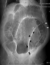 Sigmoid Volvulus