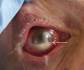 Streptococcus pneumoniae keratitis