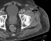 Necrotizing fasciitis associated with acupuncture: A case report