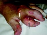 Severe tophaceous gout