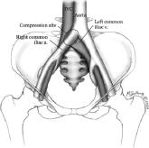 Iliac vein compression syndrome: An underdiagnosed cause of lower extremity deep venous thrombosis
