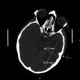 Malignant Otitis Externa