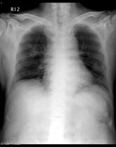 CIPNM in Disseminated Cryptococcal Infection