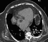 Doctor, my breathing is better when I lie down