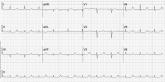 A “Routine” Electrocardiogram (ECG)