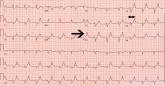 Electrocardiographic changes of severe hyperkalemia
