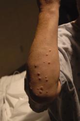 Acute Pancreatitis with Eruptive Xanthomas