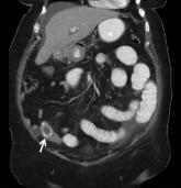 Small Bowel Obstruction by Gallstone Ileus