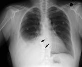 Port‐A‐Cath Embolization