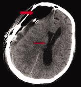 Tension Pneumocephalus as Complication of Hematoma Evacuation
