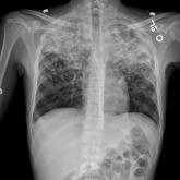 TB with Pott's Disease and Psoas Abscess