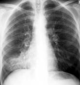 Community‐Acquired Pneumonia