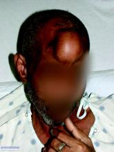 Bony Metastatic Disease