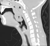 Suppurative complications and upper airway obstruction in infectious mononucleosis