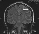 Diagnosis of Exclusion