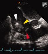 Unusual Cardiac Rhythm Device Infection