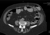 Solifenacin‐Induced Small Bowel Pseudo‐Obstruction